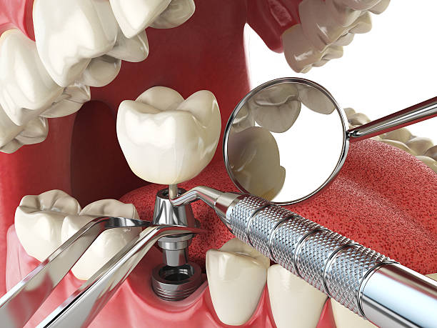 Best Emergency Dental Care for Sports Injuries in Clayton, OH